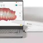 SCANNER INTRA-ORAL